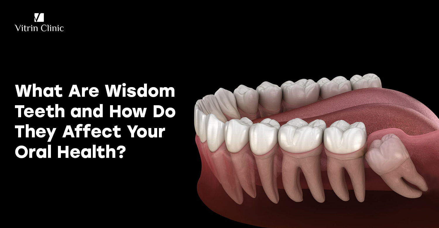 wisdom tooth