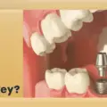 Is the Abutment Placement Procedure in Turkey Safe & Effective 2026?