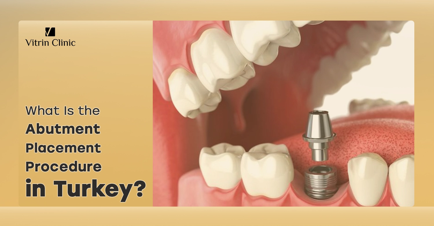 Abutment placement procedure