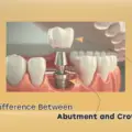 Abutment vs Crown: 5 Key Differences Explained Clearly 2026