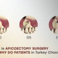 Why Is Apicoectomy Surgery in Turkey the #1 Trusted Dental Solution for 2026?