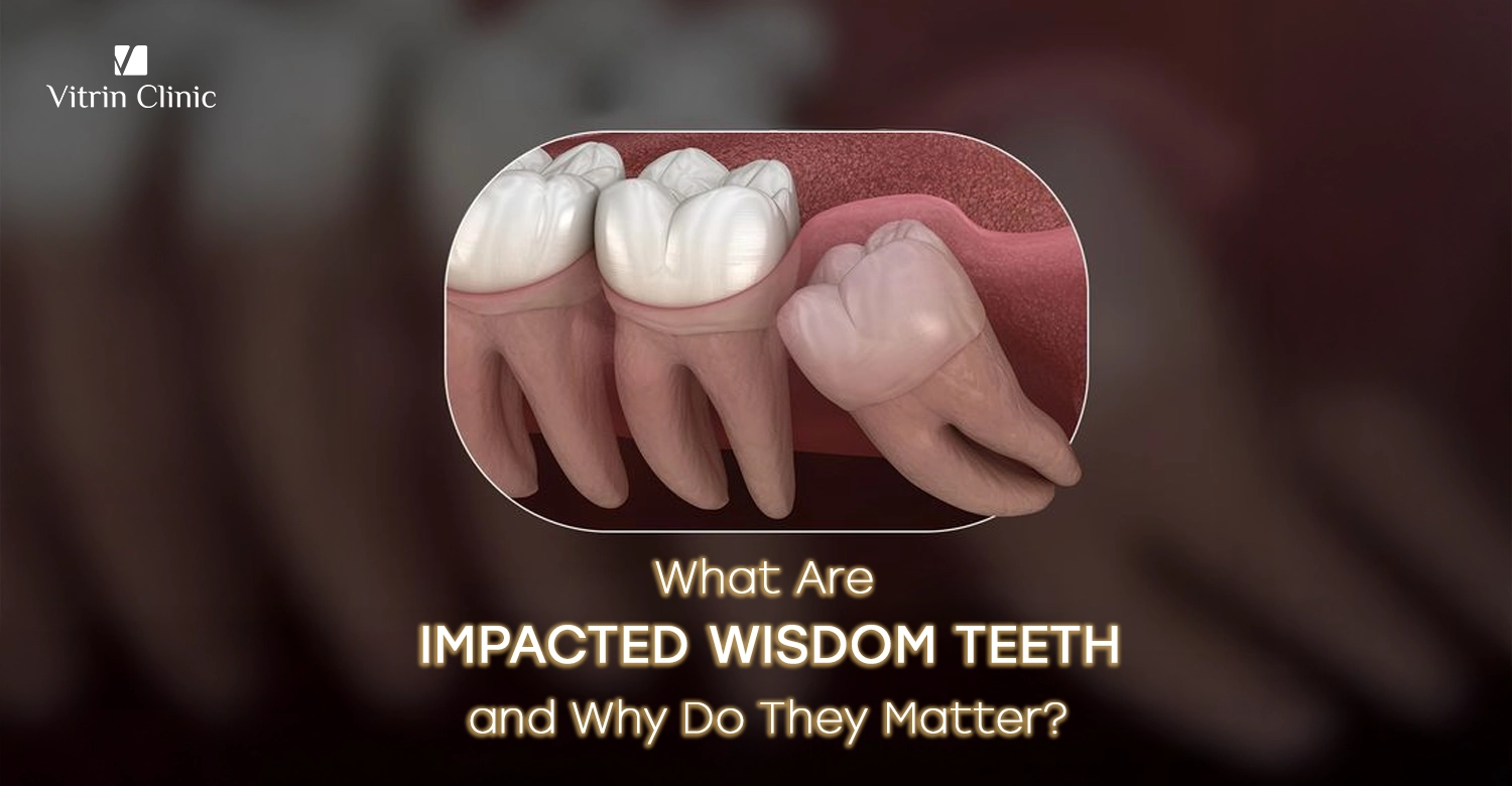 Impacted wisdom teeth