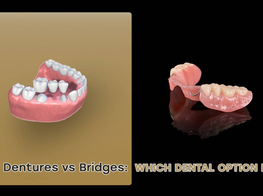 Partial dentures vs bridges