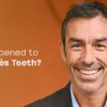 Robert Pirès Teeth: What’s the Real Story Behind His Smile?