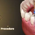 Why Is the Root Canal Procedure the 5-Step Solution to a Healthy Smile in 2026?