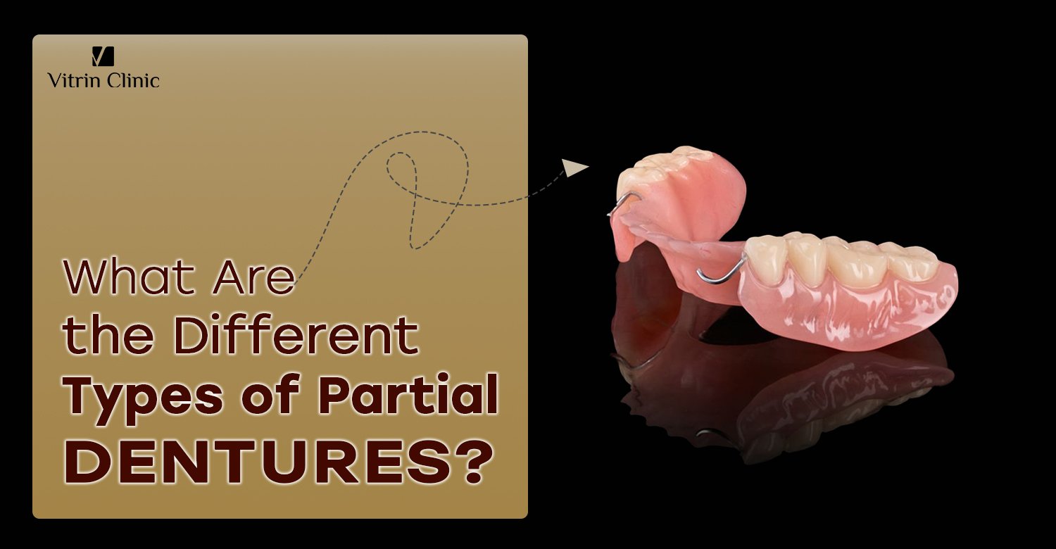 Types of partial dentures