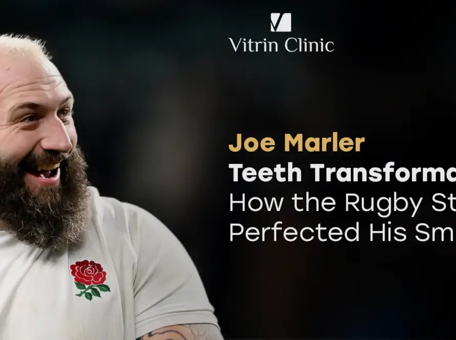 Joe Marler Teeth Transformation
