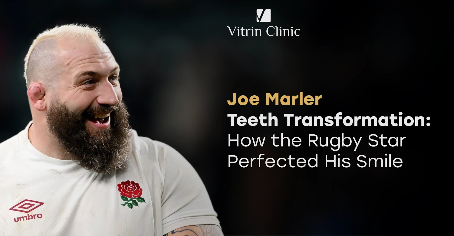 Joe Marler Teeth Transformation
