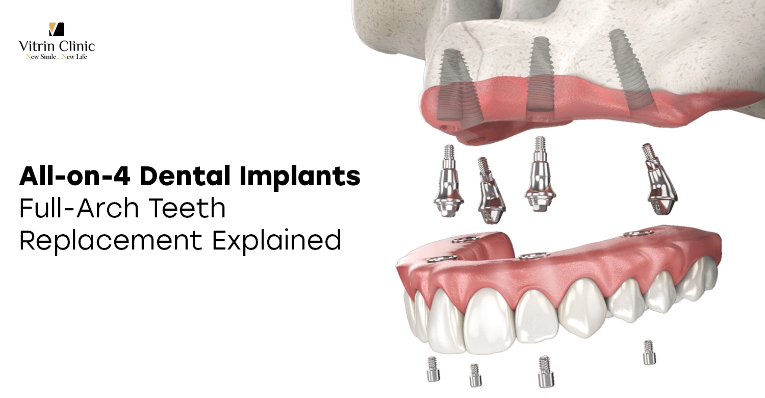 All-on-4 Dental Implants