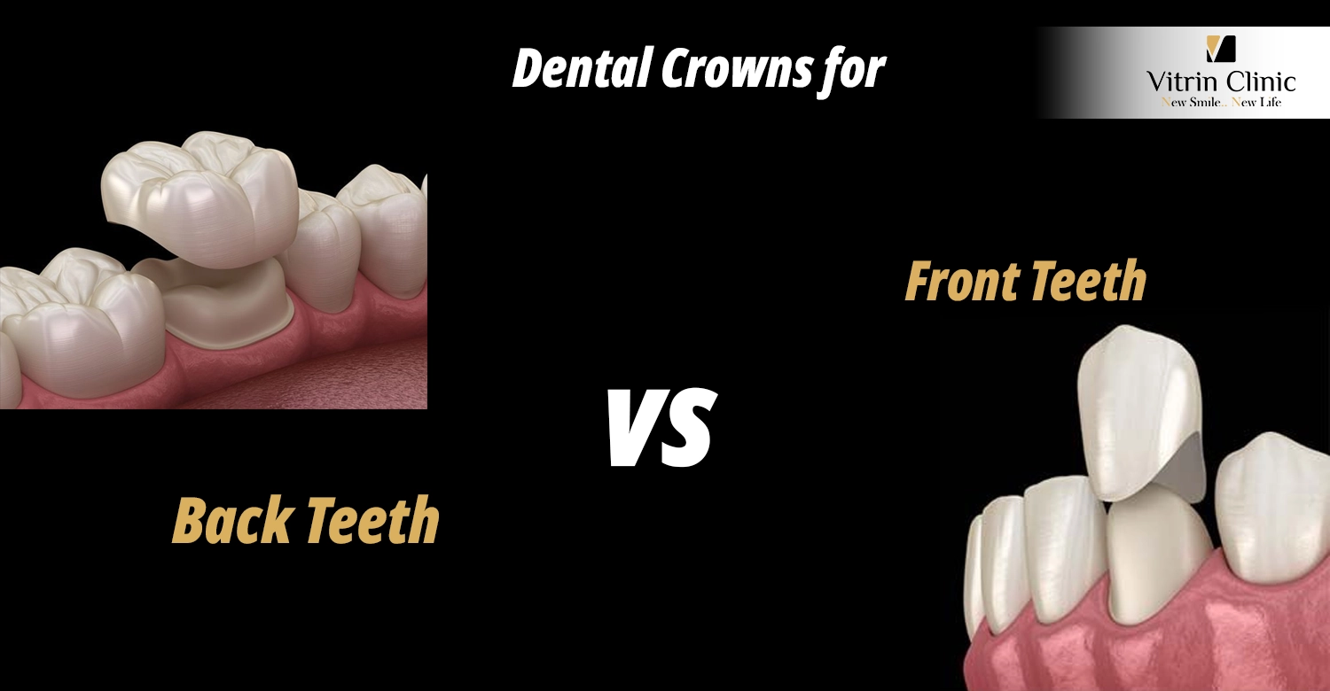 Dental Crowns for Front Teeth vs. Back Teeth.webp