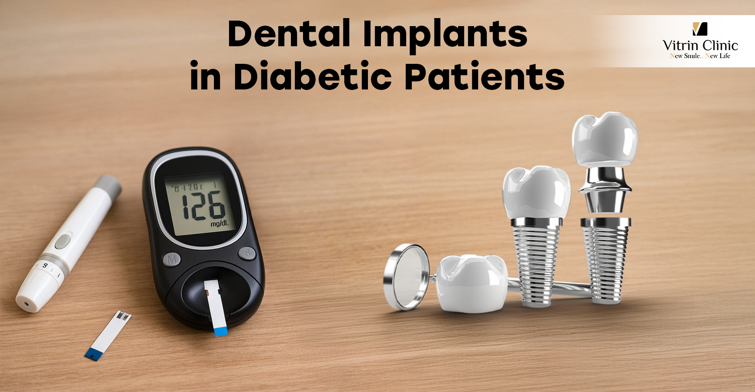 Dental Implants in Diabetic Patients