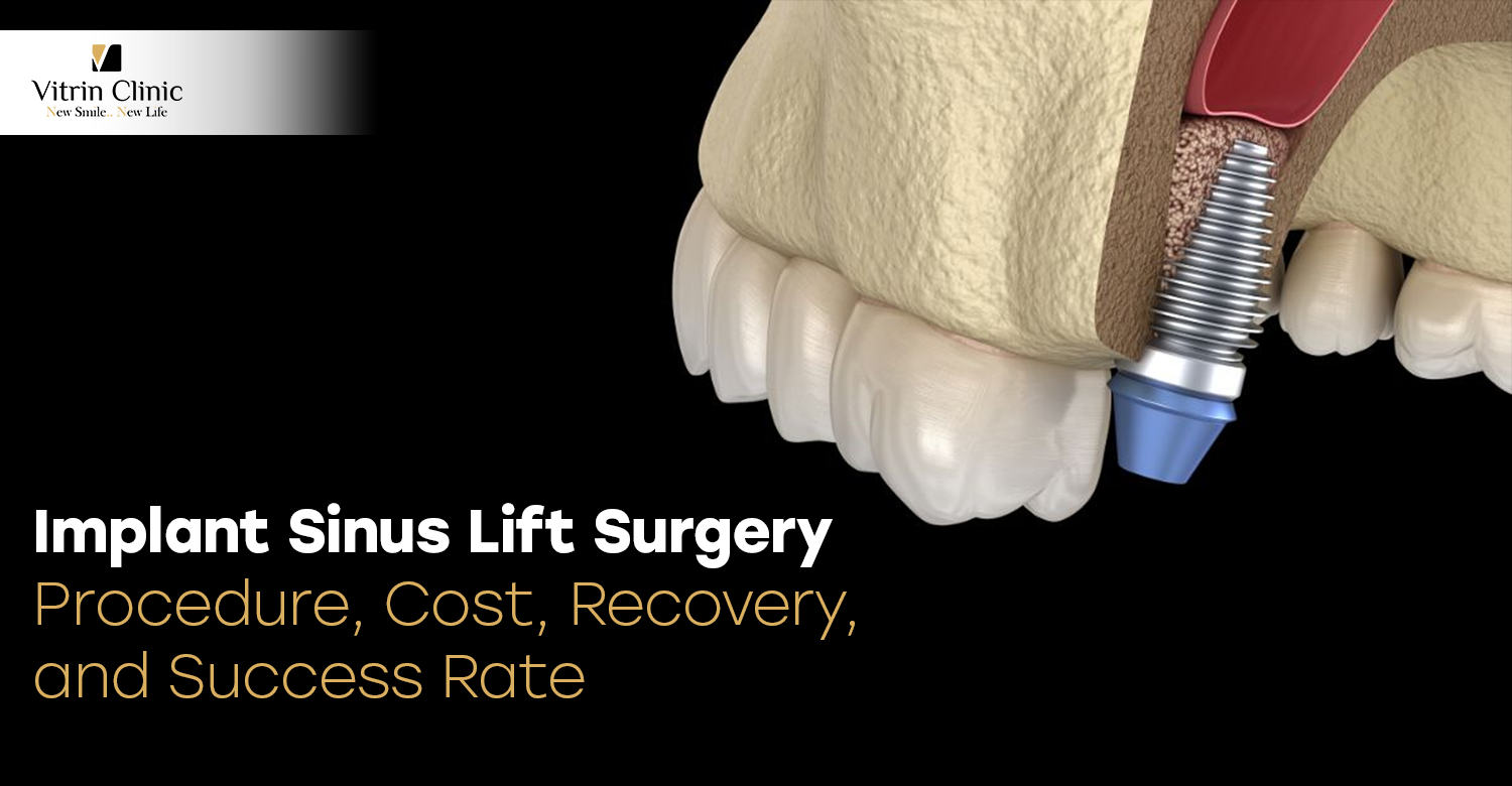 Implant Sinus Lift Surgery