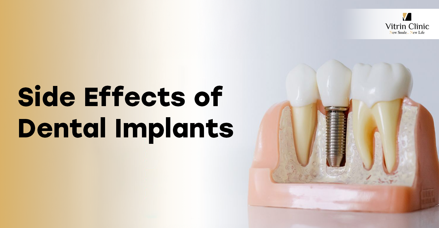 Side Effects of Dental Implants
