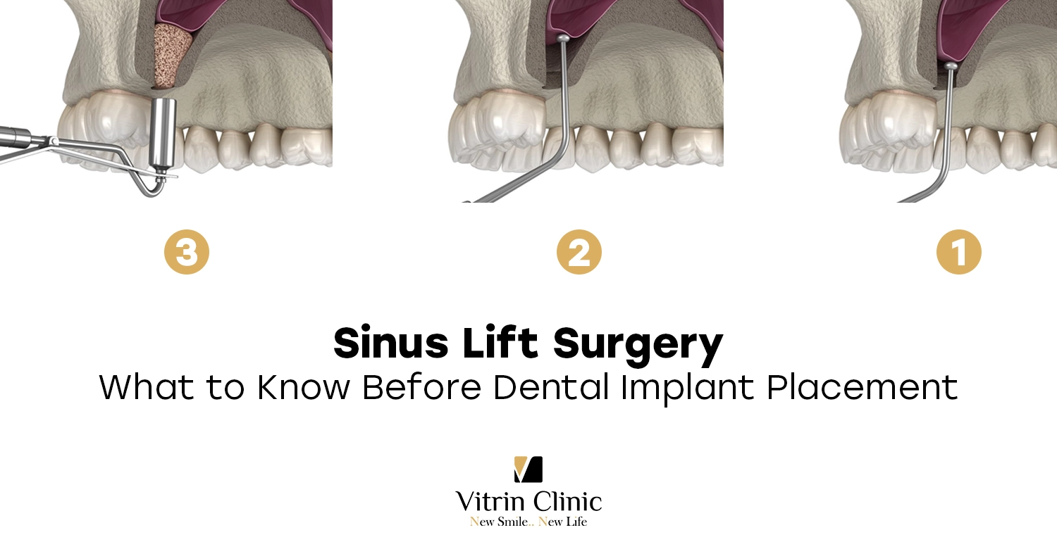 Sinus Lift Surgery