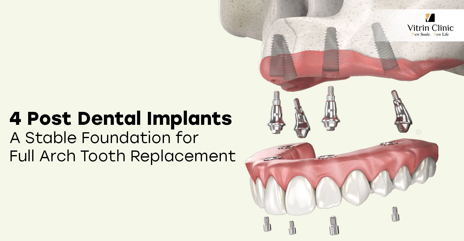 4 Post Dental Implants