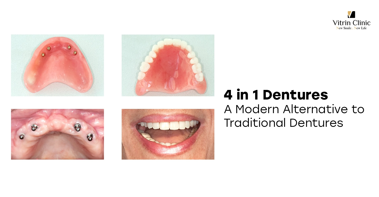 4 in 1 dentures