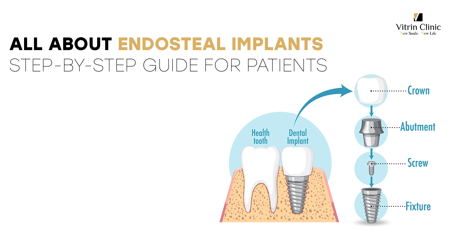 All About Endosteal Implants