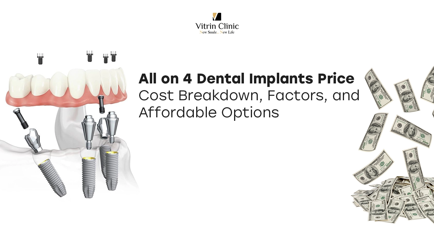all on 4 dental implants price