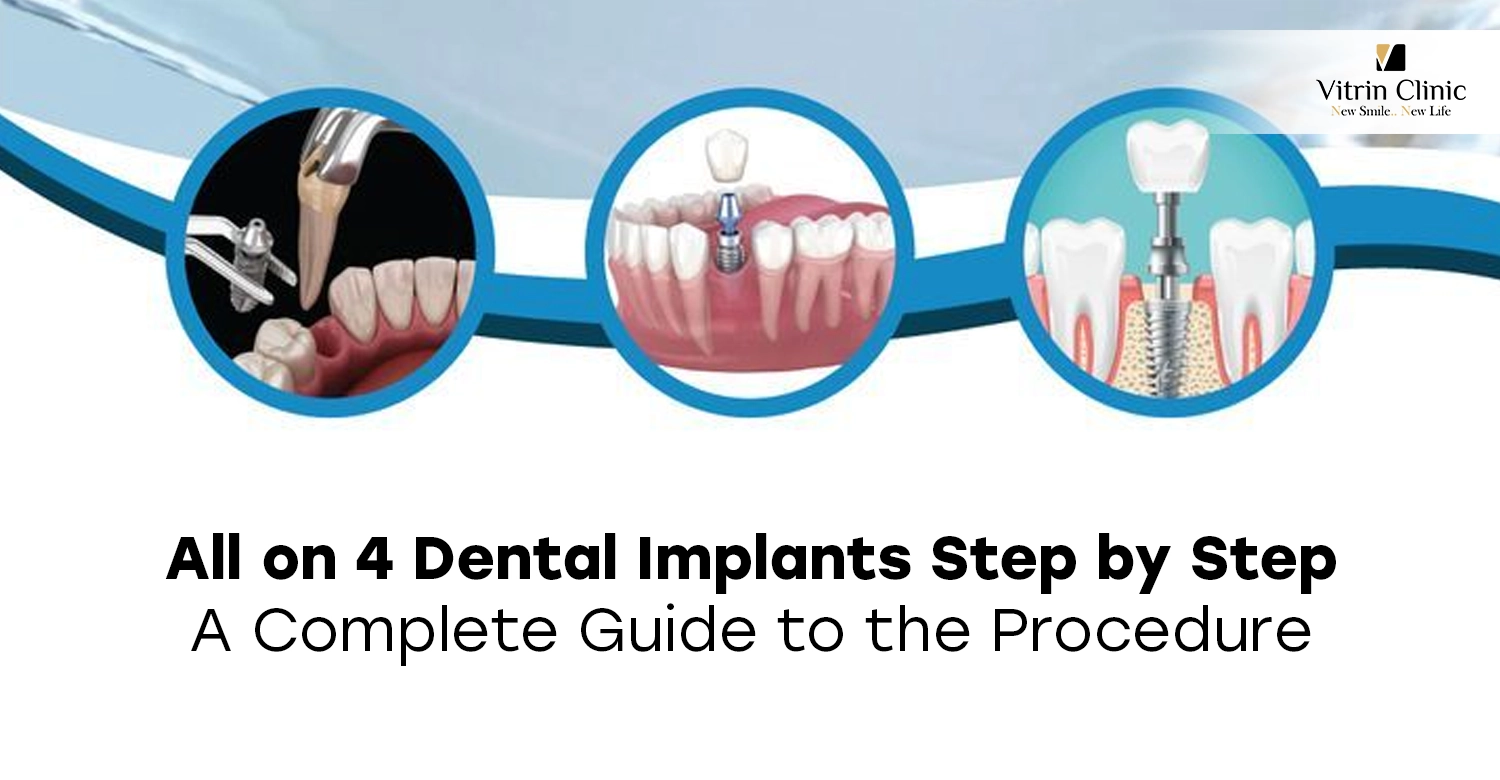 all on 4 dental implants step by step