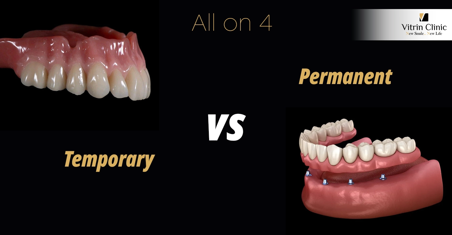 All on 4 Temporary vs Permanent