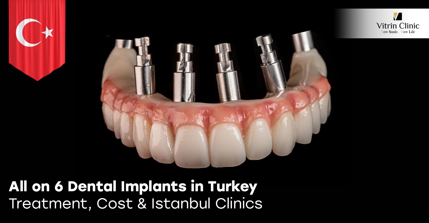 All on 6 Dental Implants in Turkey
