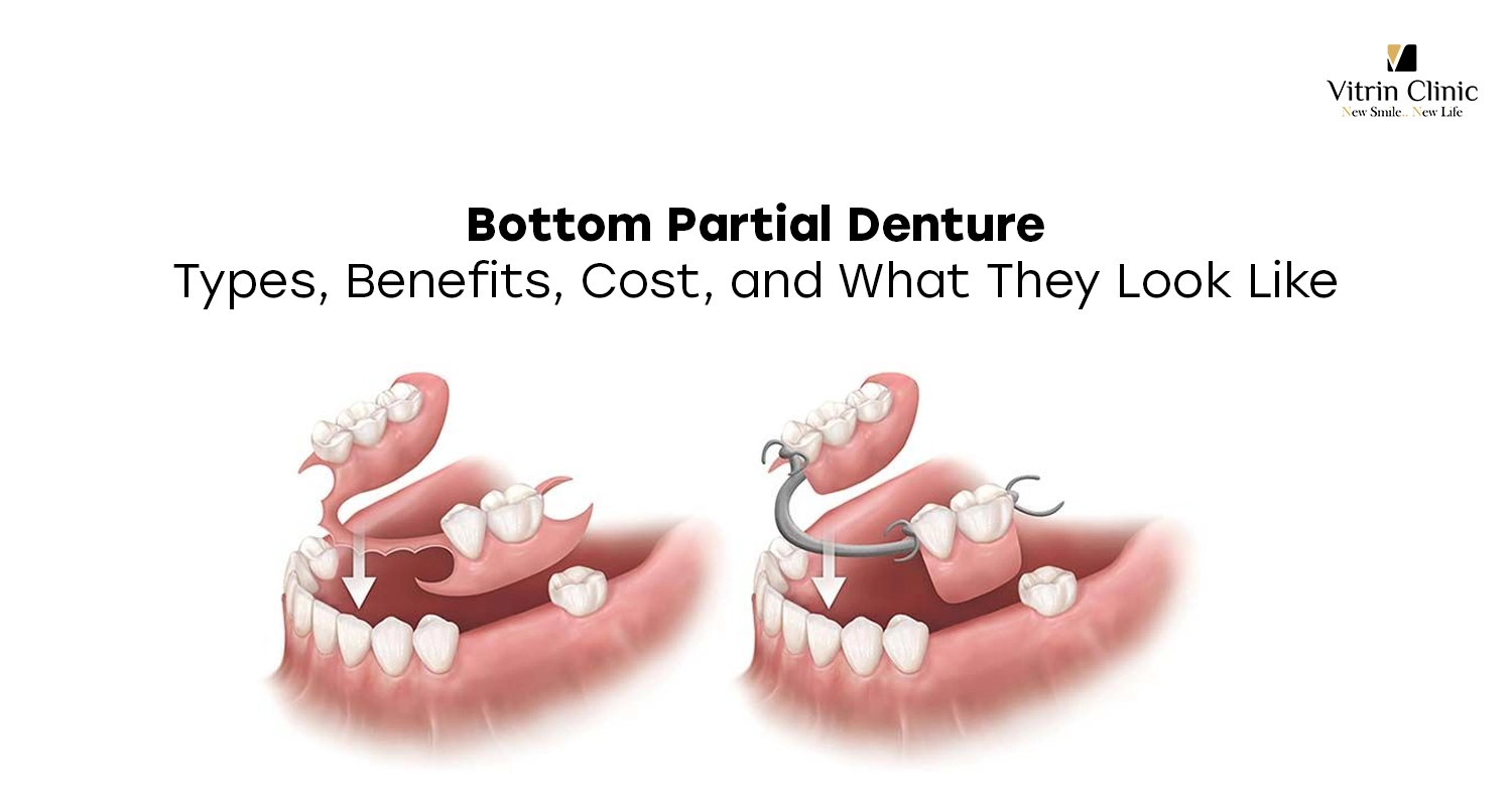 Bottom Partial Denture