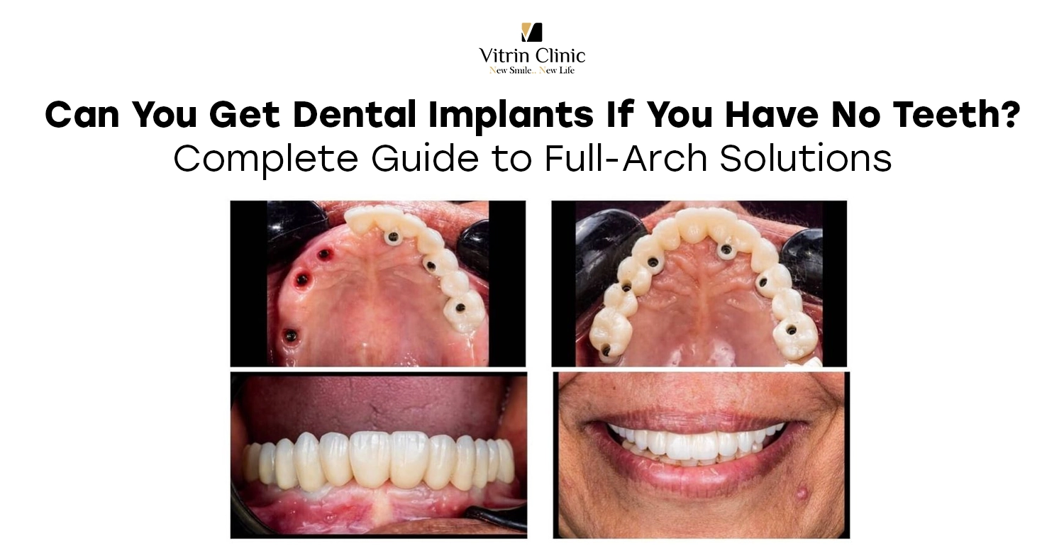 Can you get dental implants if you have no teeth