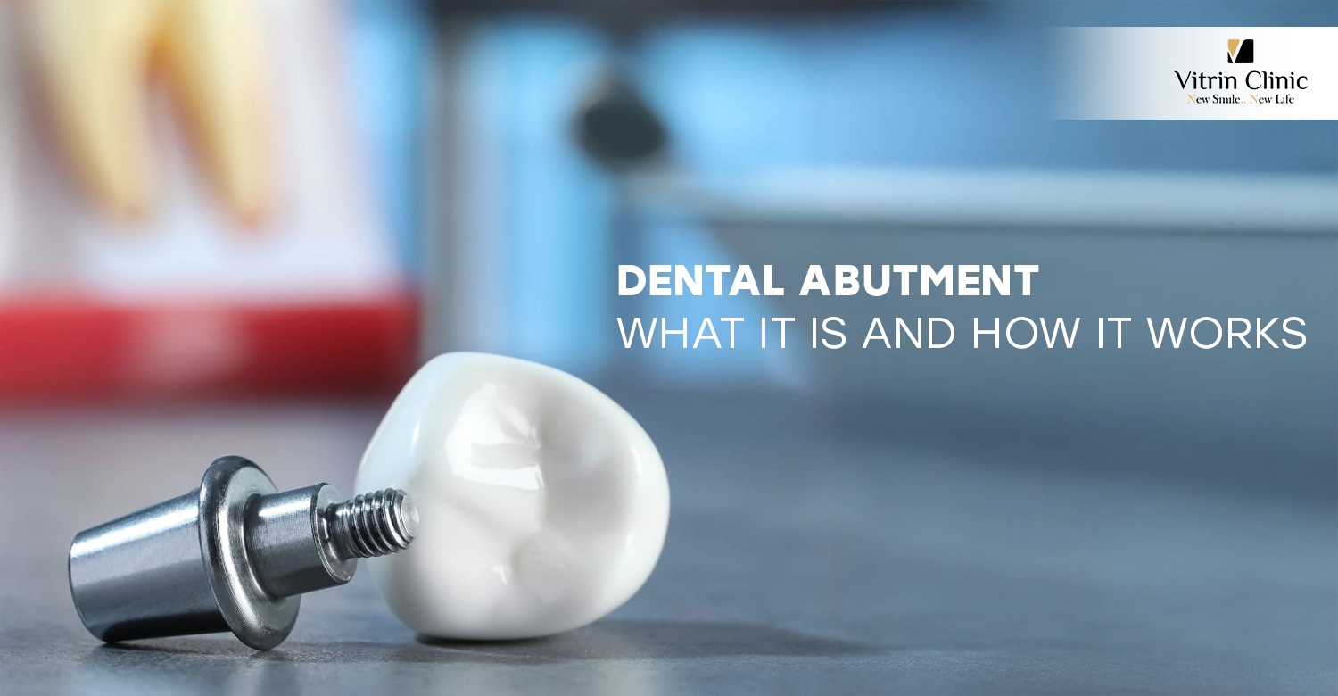 dental abutment