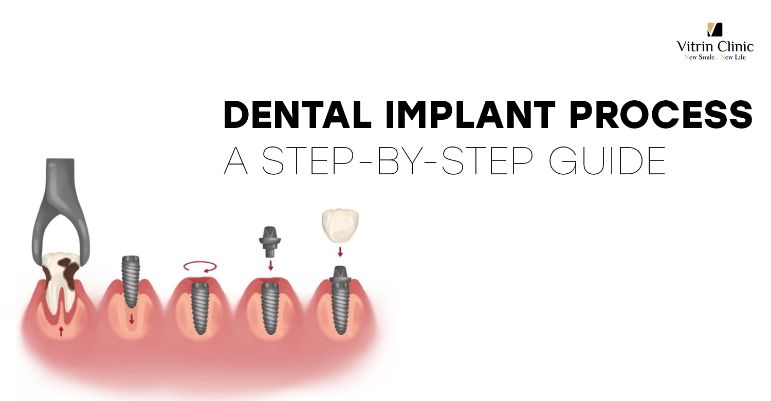 Dental Implant Process