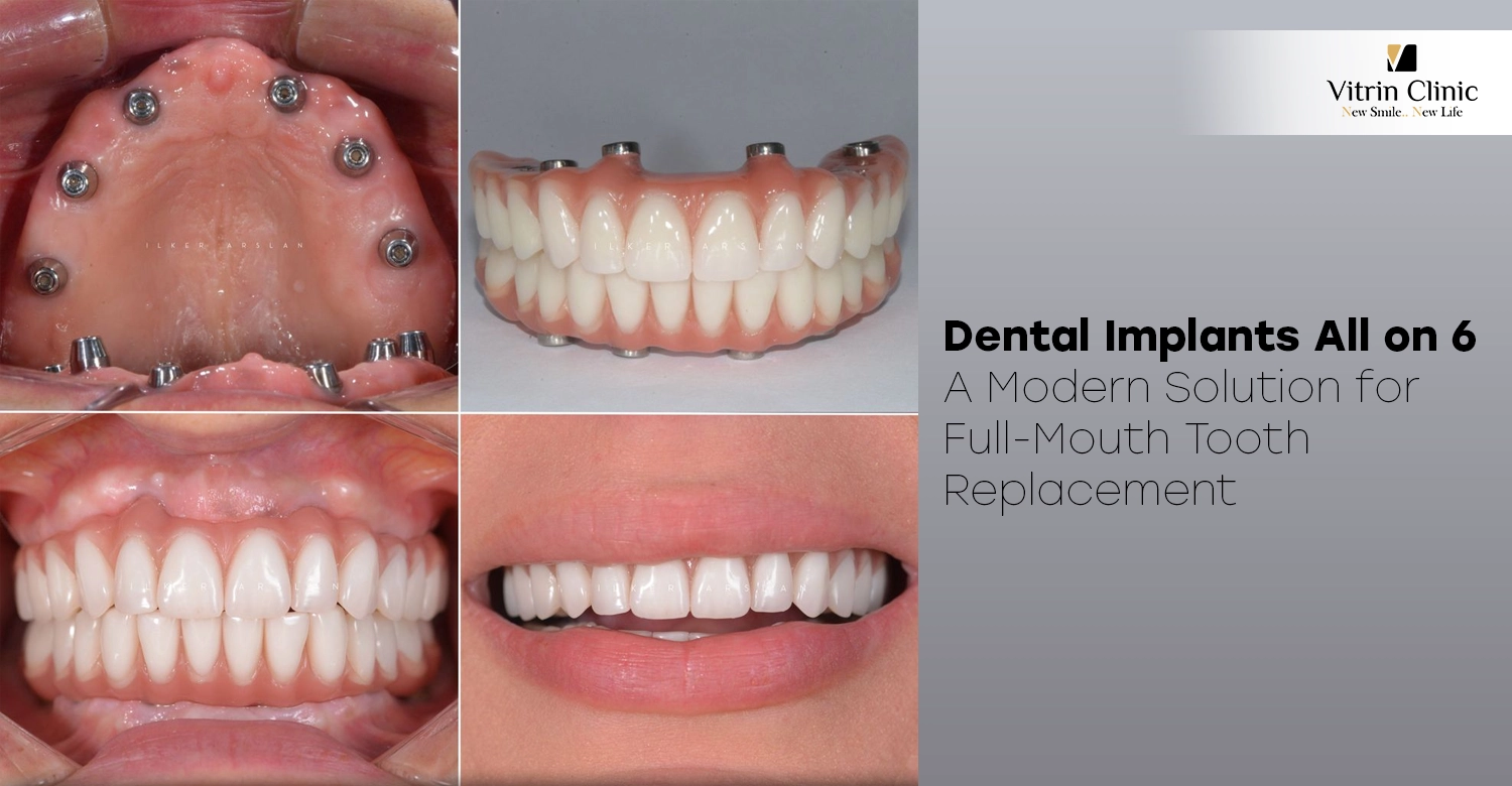 Dental implants all on 6
