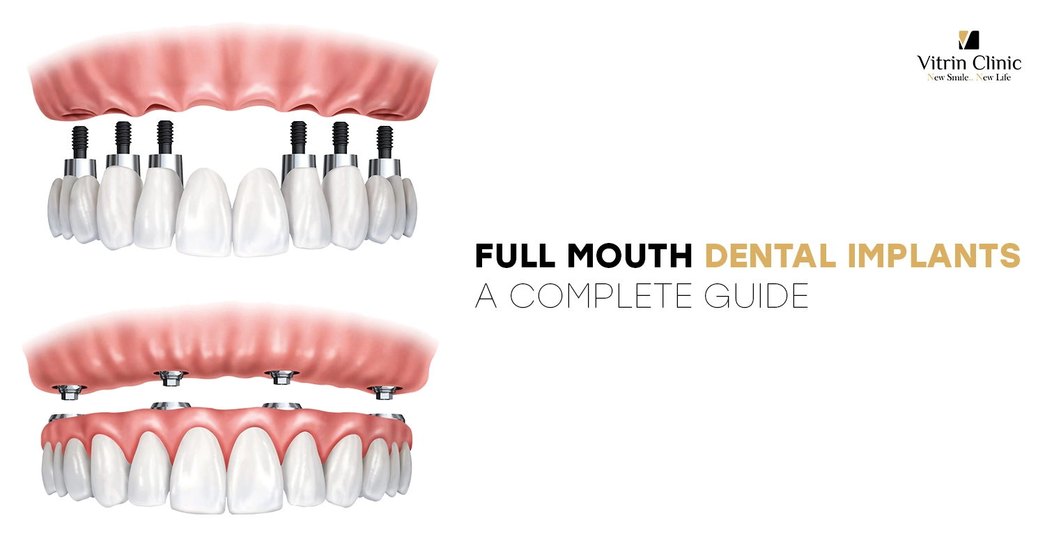 Full Mouth Dental Implants