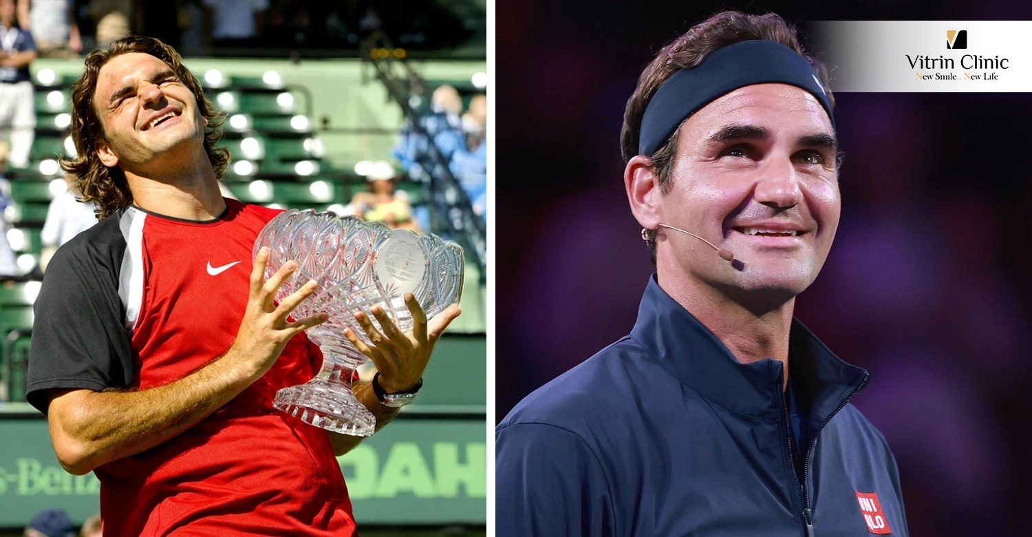 Roger Federer Teeth Before and After