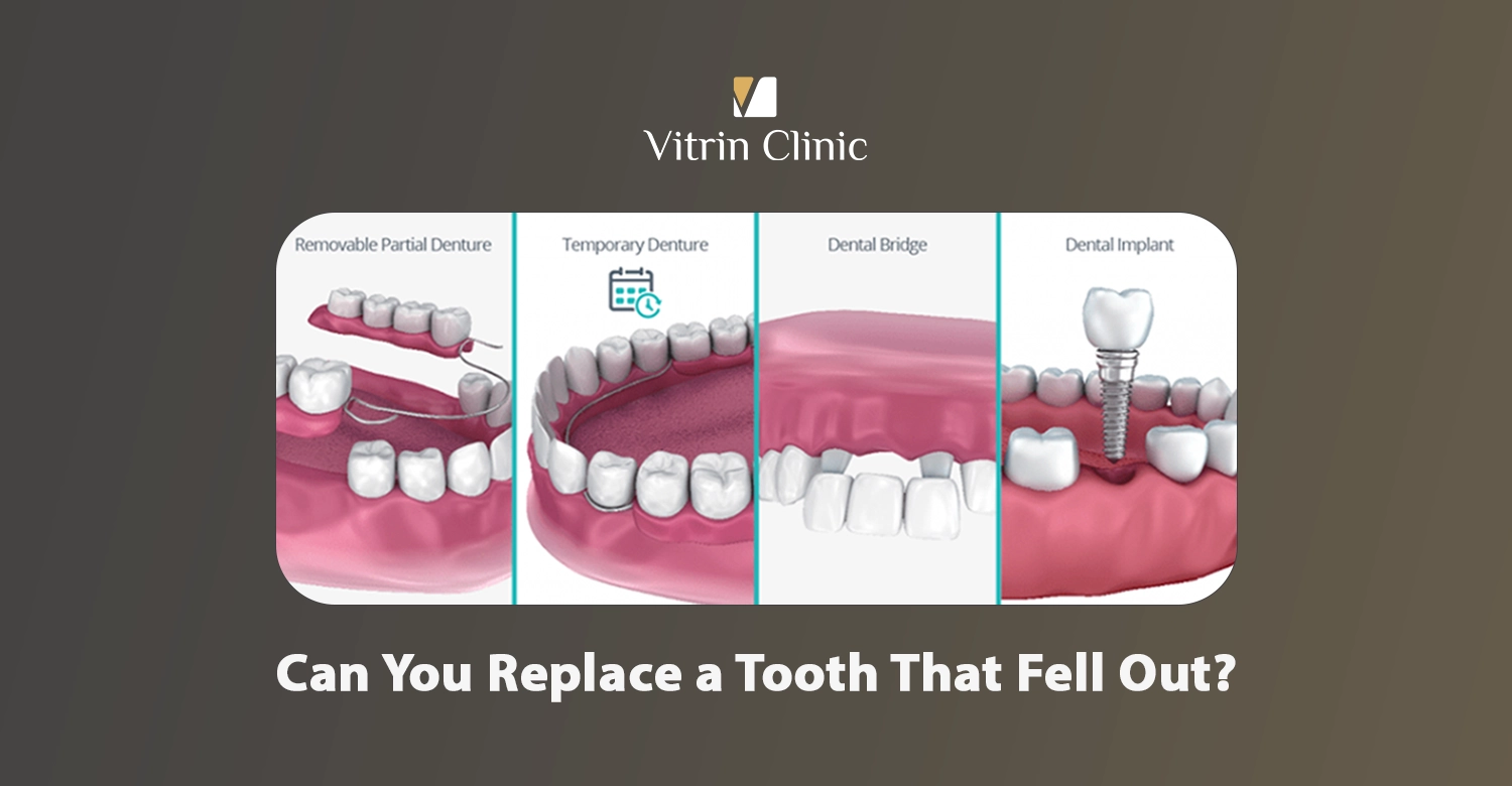 Can you replace a tooth that fell out