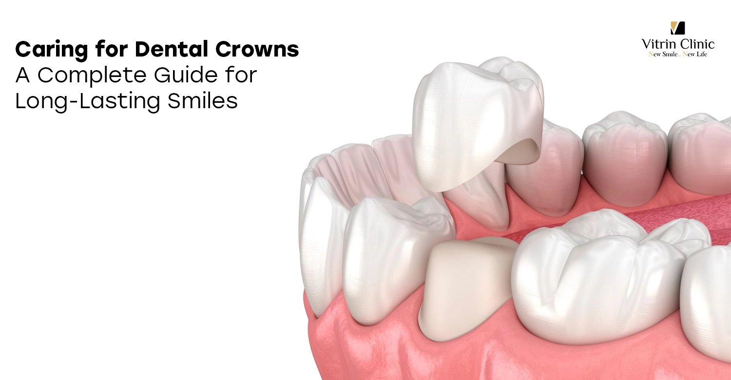 Caring for Dental Crowns