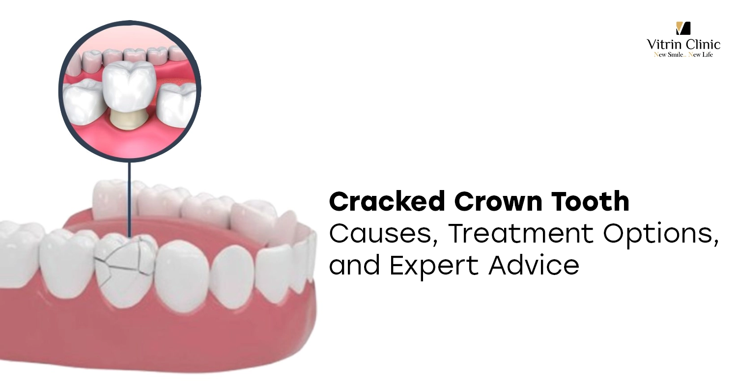 Cracked Crown Tooth