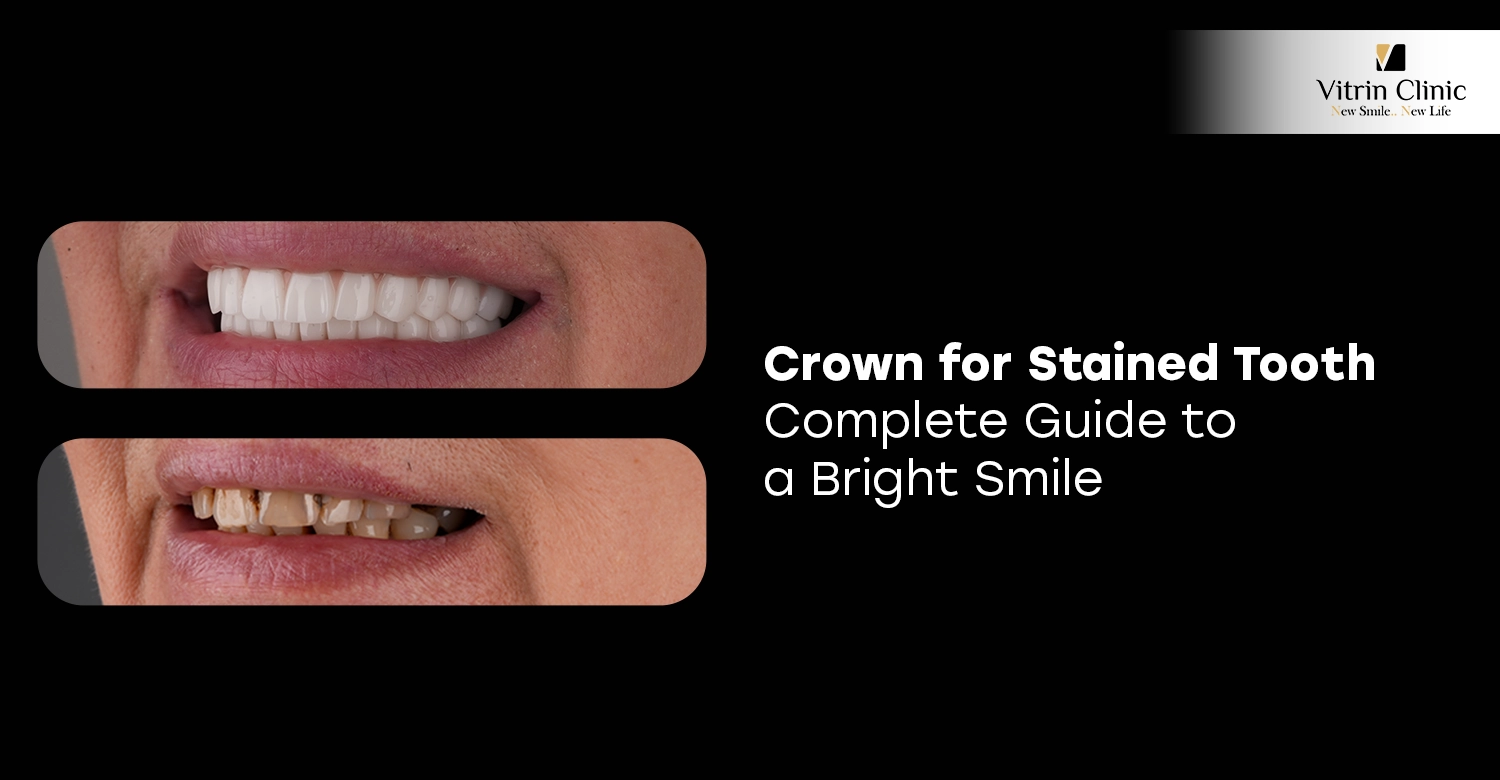 Crown for Stained Tooth