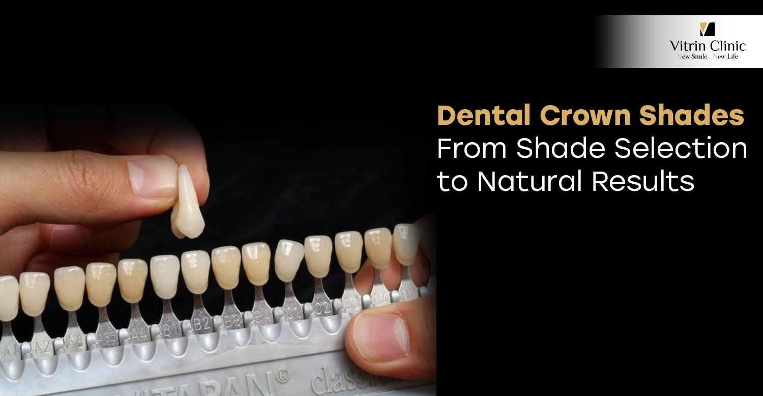 Dental Crown Shades