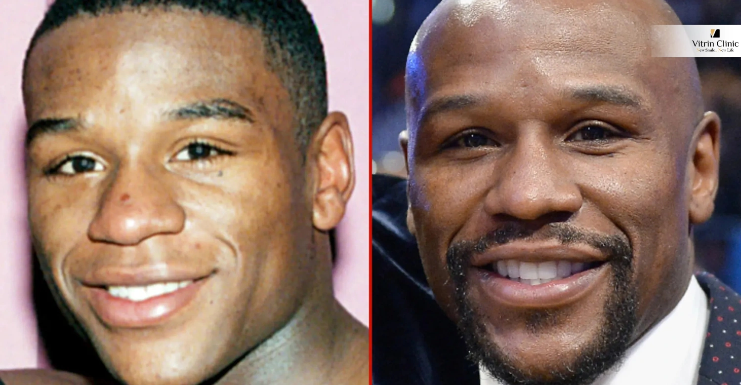 Floyd Mayweather Teeth Before Veneers: The Early Career Look Fans Rarely Discuss
