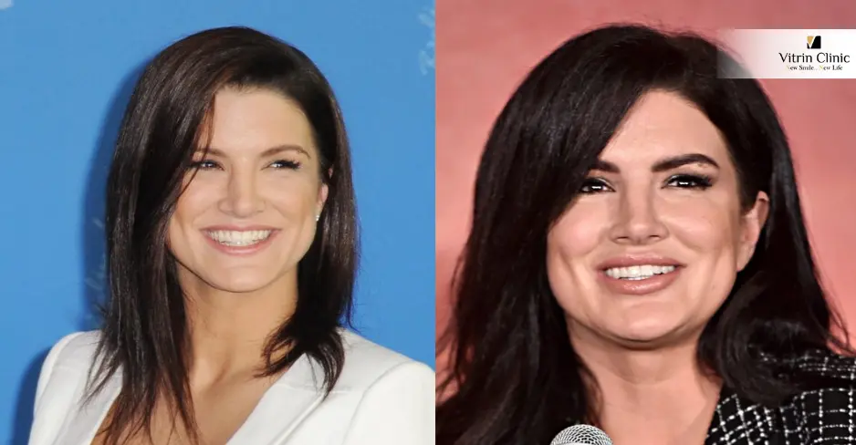 Before and After: The Evolution of Gina Carano Smile