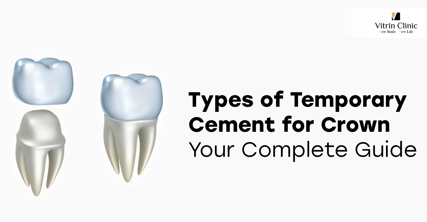 types of temporary cement for crown