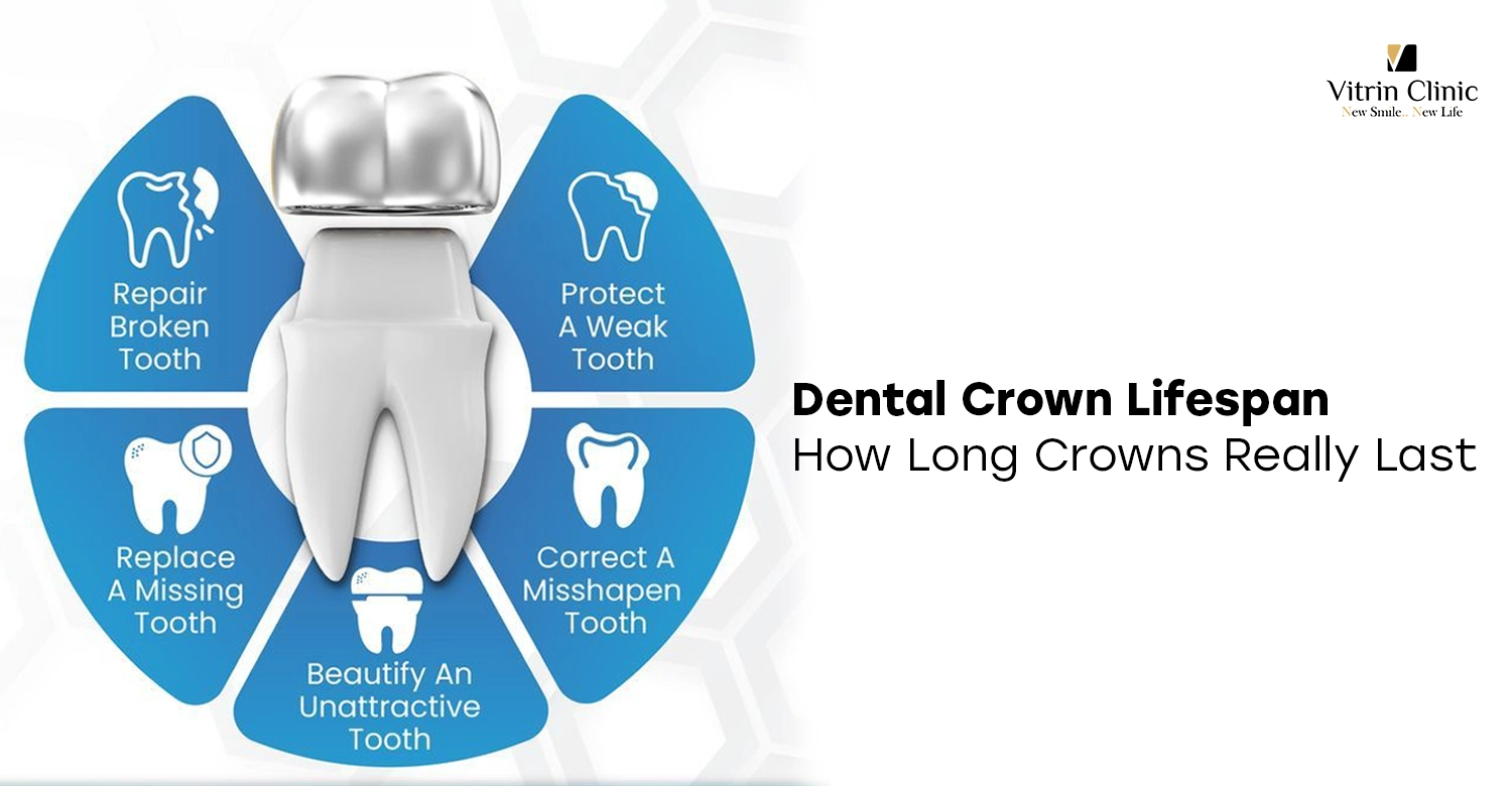 Dental Crown Lifespan