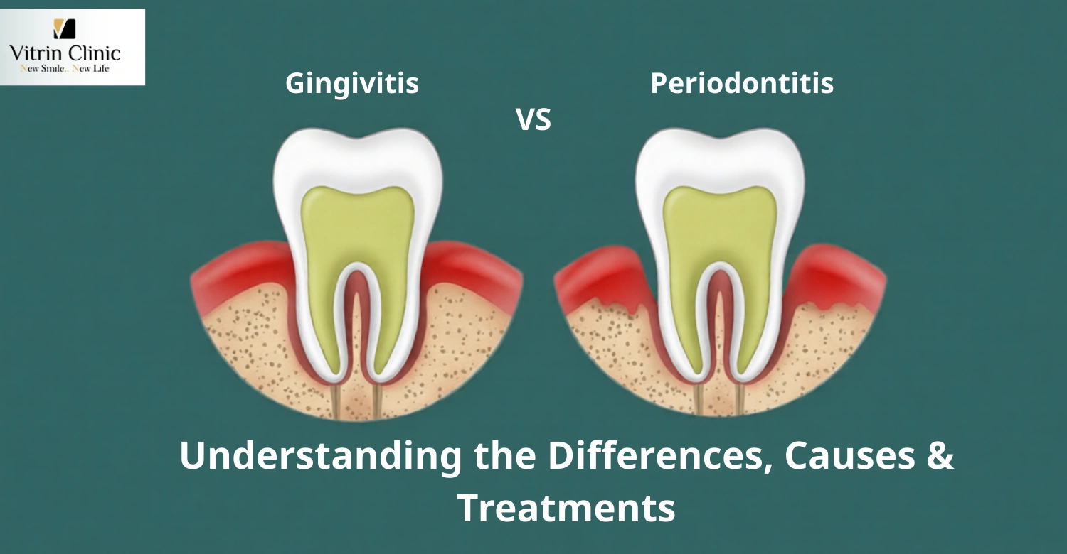 Gingivitis vs Periodontitis