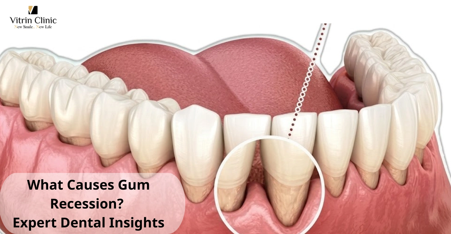 what causes gum recession
