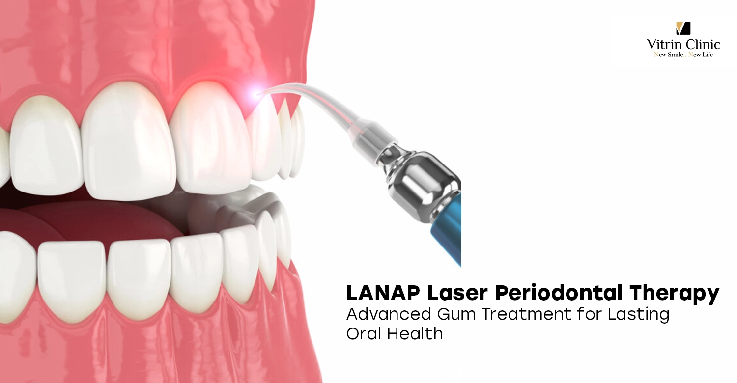 LANAP Laser Periodontal Therapy