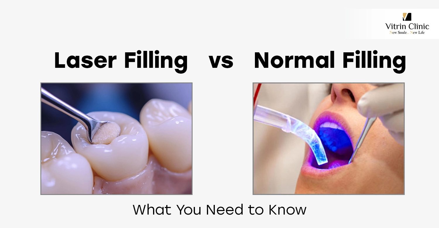 Laser Filling vs Normal Filling