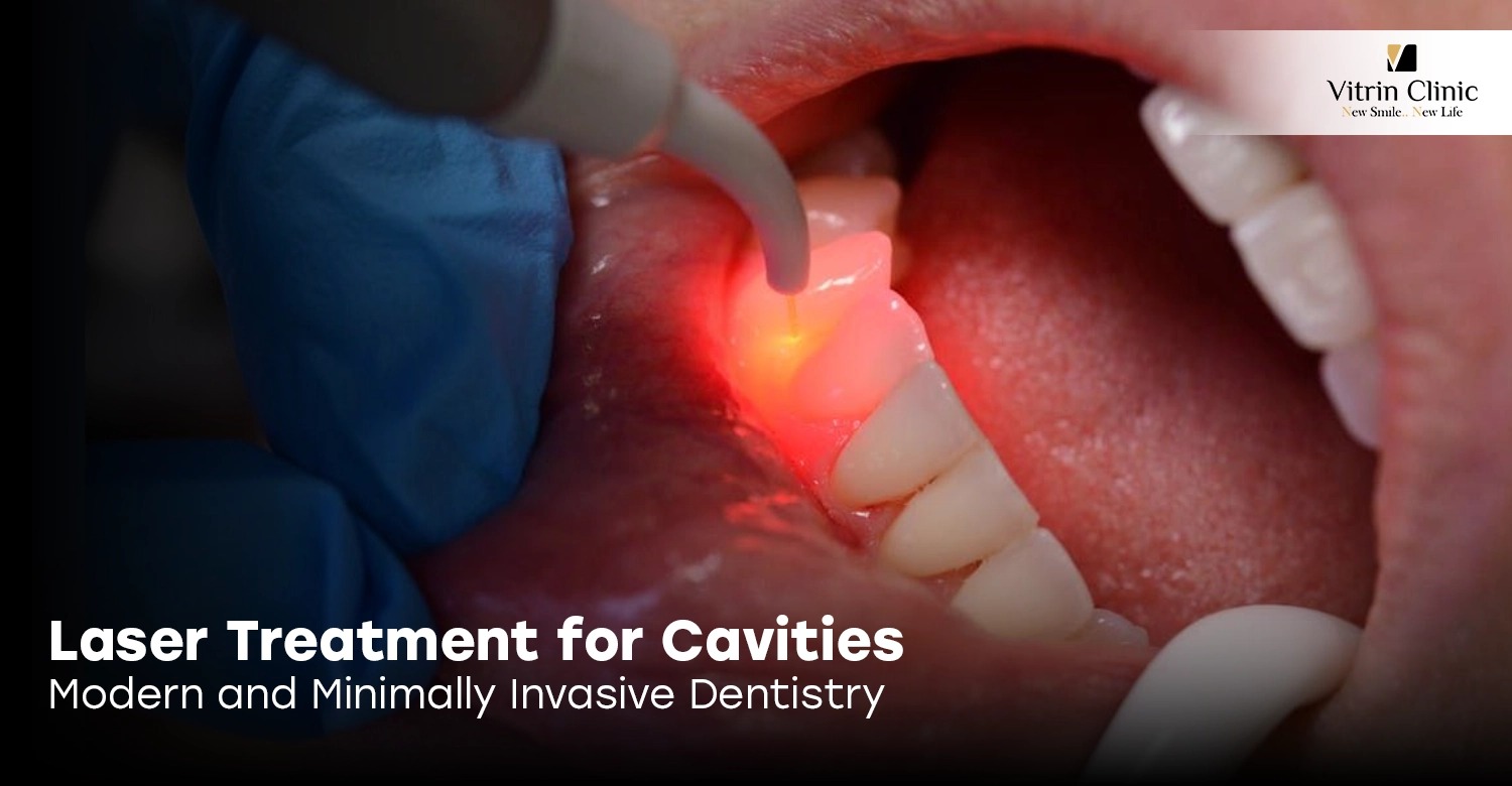 Laser Treatment for Cavities