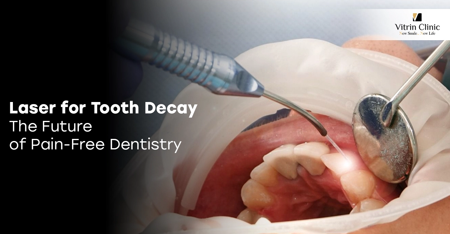 Laser for Tooth Decay