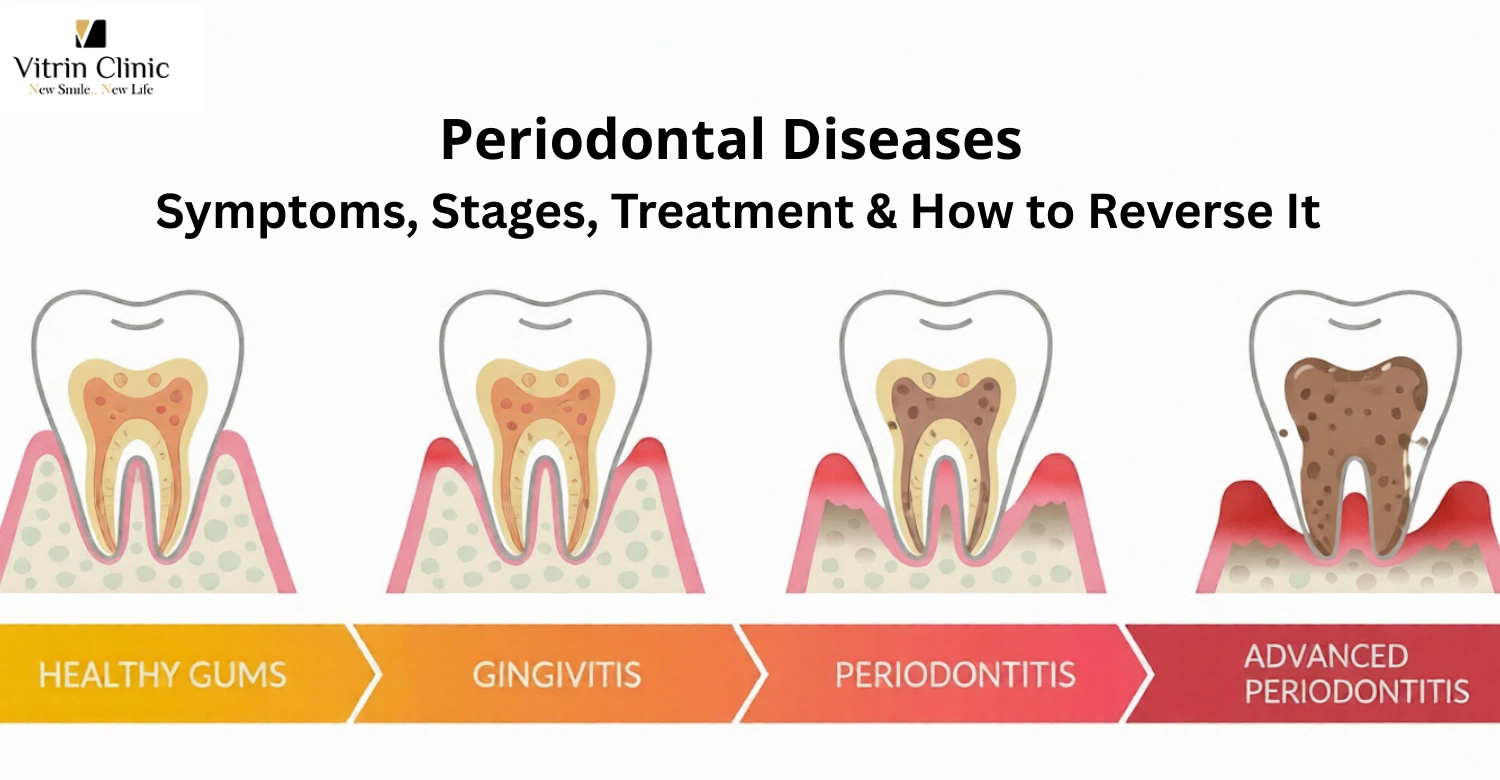 periodontal disease