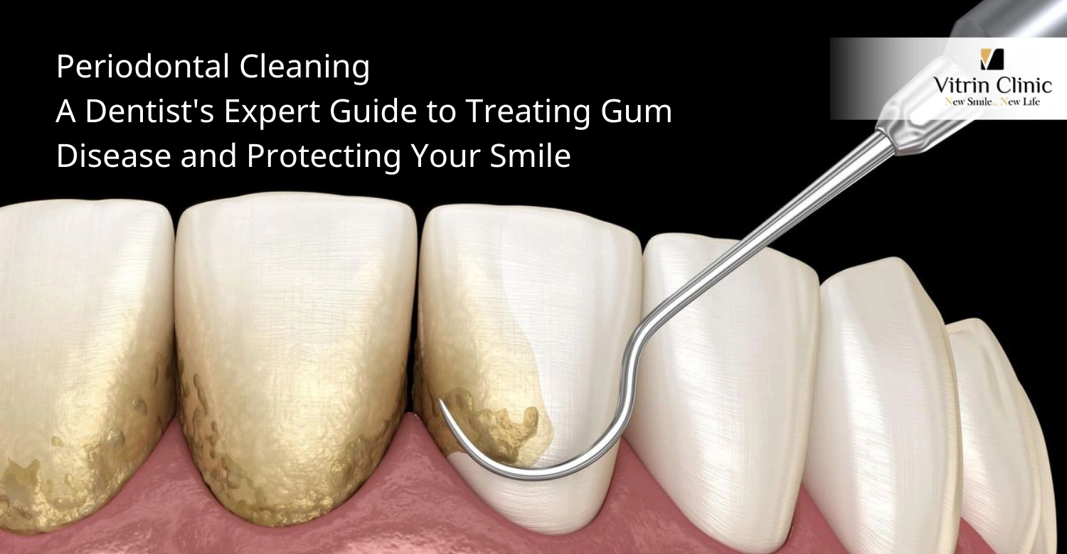Periodontal Cleaning Guide: Costs & Results | Vitrin Clinic