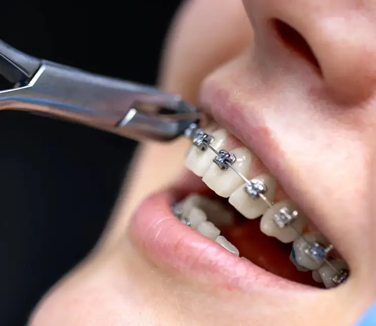 Benefits-of-Orthodontic-Treatment-Copy (1) copy